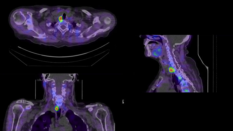 Spect-DT-bild på lokalisering av bisköldkörteladenom hos en 73-årig kvinnlig patient.